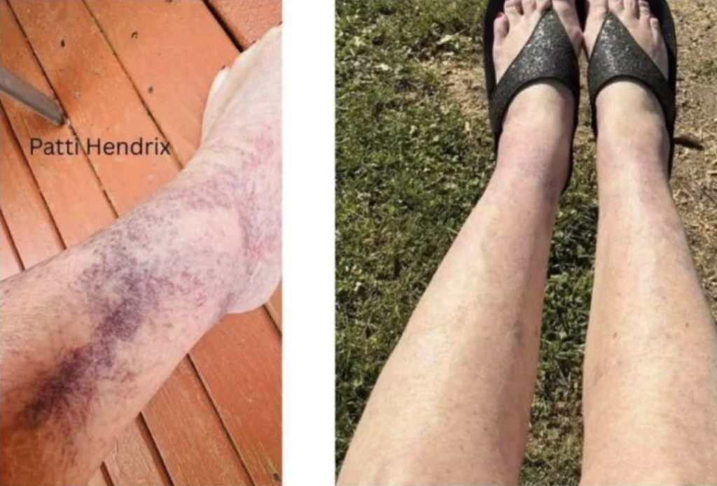 OlyLife reviews spider veins on legs